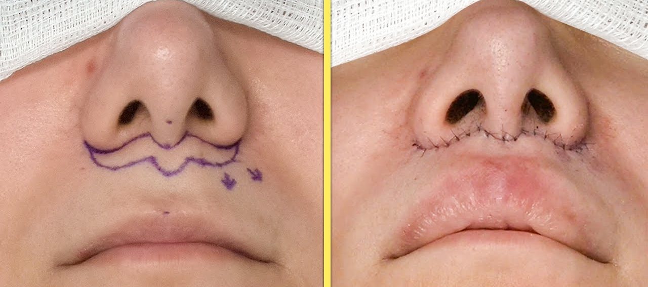 Lip Lift surgery