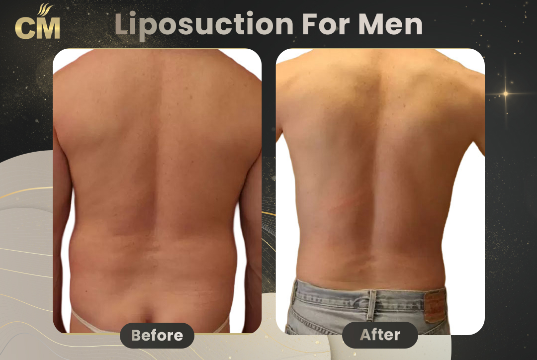 Liposuction For Men Before After-20