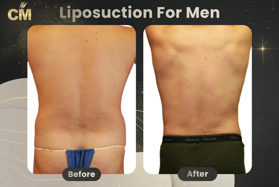 Liposuction For Men Before After-4