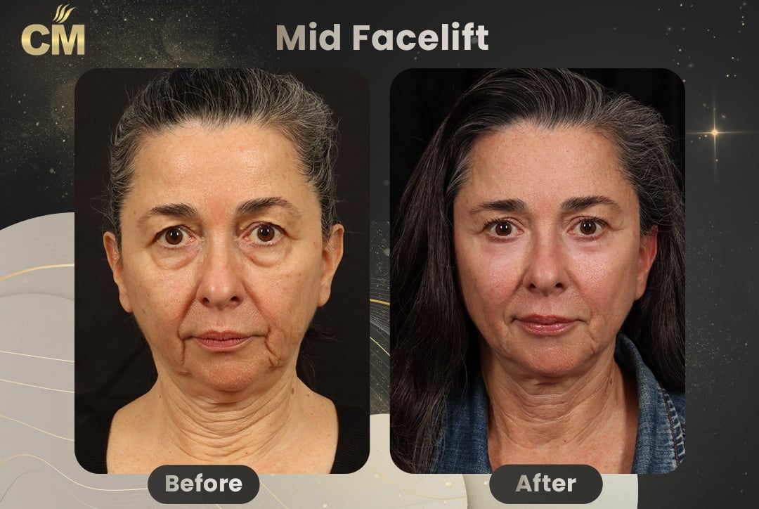 Mid Facelift Before and After-1