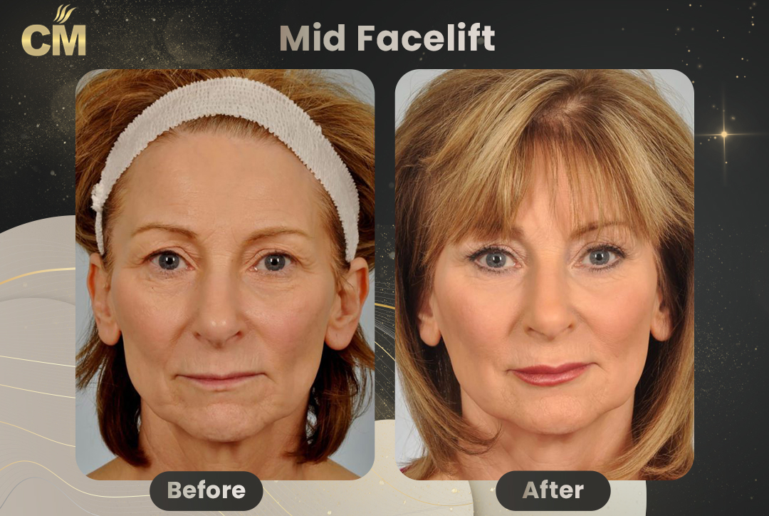 Mid Facelift Before and After