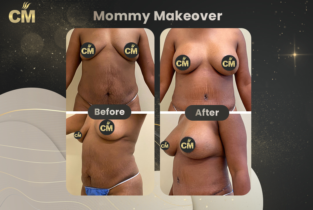 Mommy Makeover Before After-4