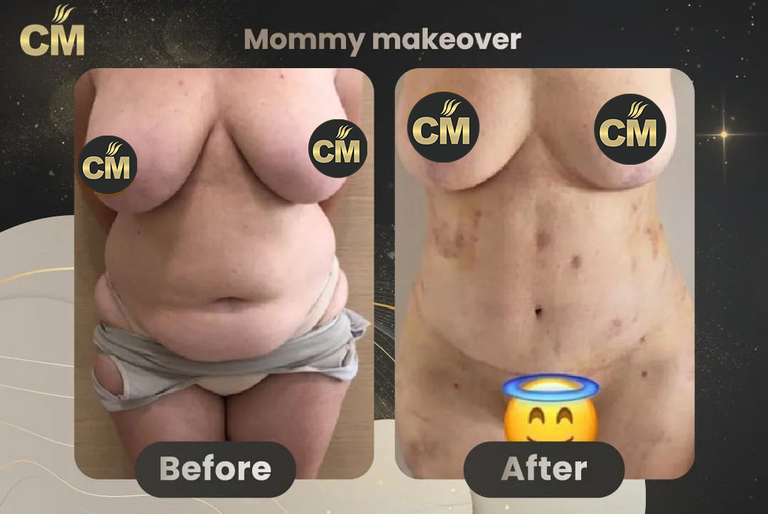 Mommy Makeover Before After-7