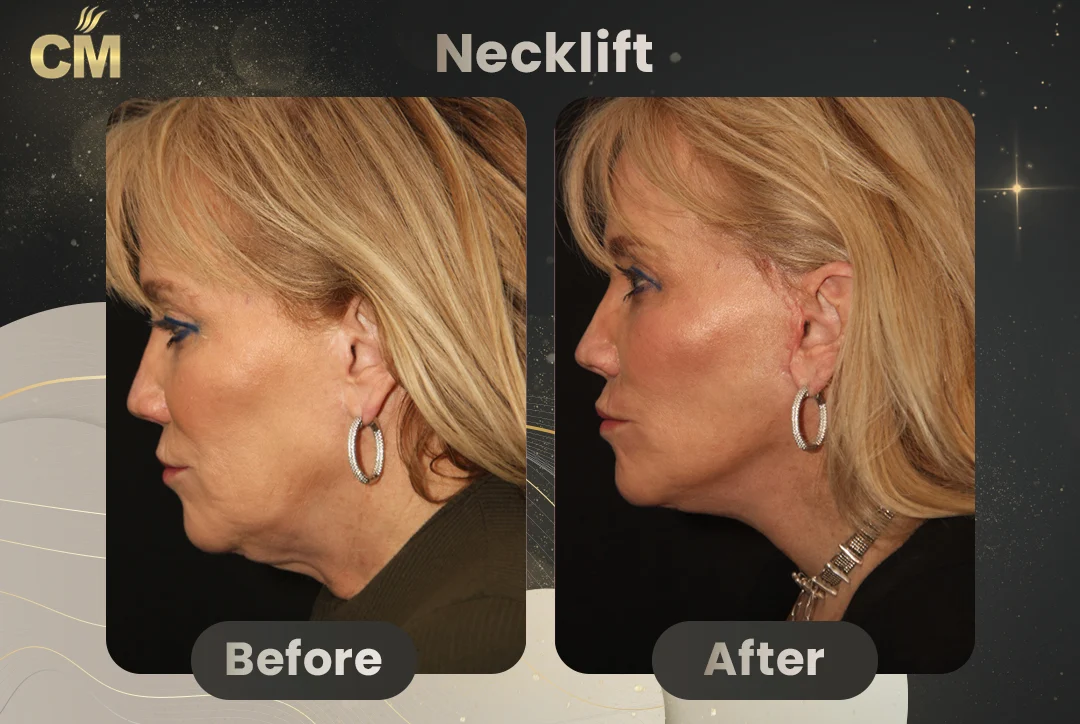 Neck Lift Before and After in Turkey for women
