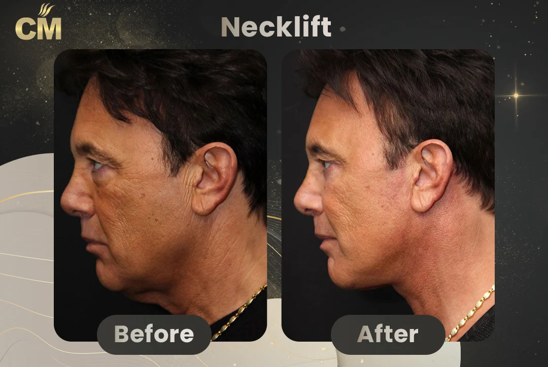 Neck Lift Before and After in Turkey for men