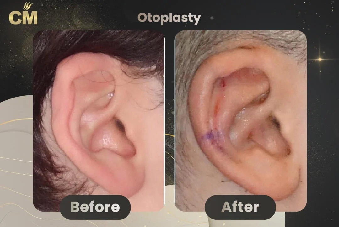 Otoplasty before and after 1