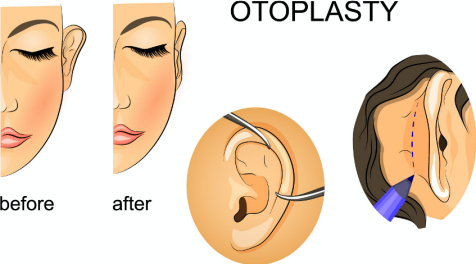 Otoplasty in turkey