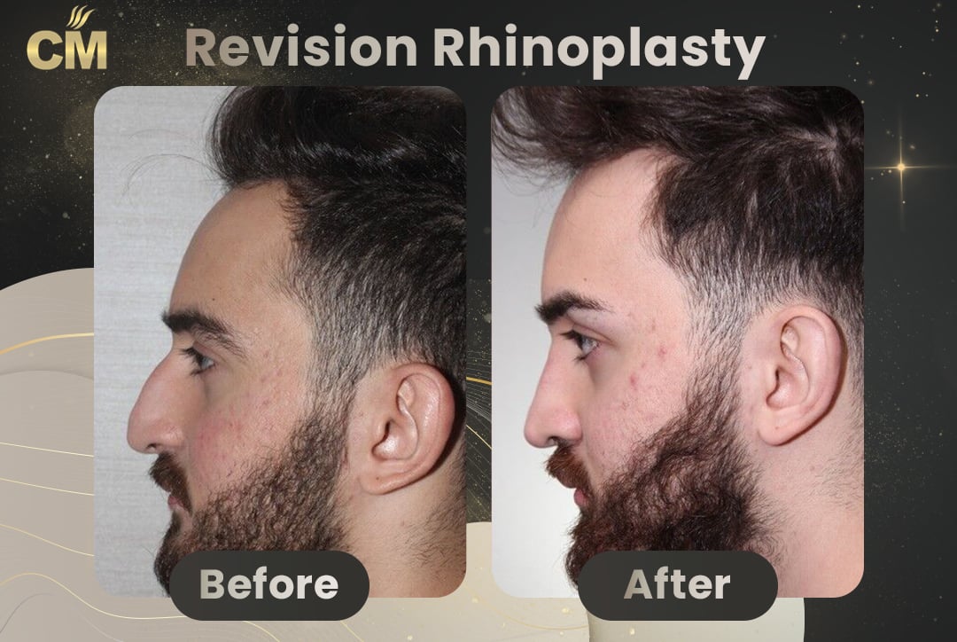 Revision Rhinoplasty Before and After in Turkey for men