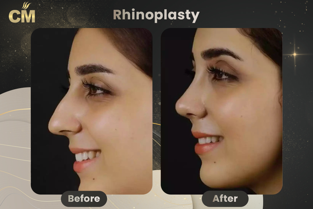 Rhinoplasty Before and After in Turkey for women