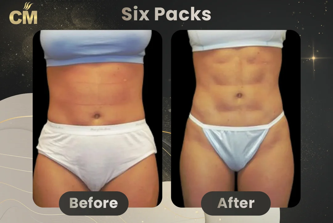 Six Packs Before After for women