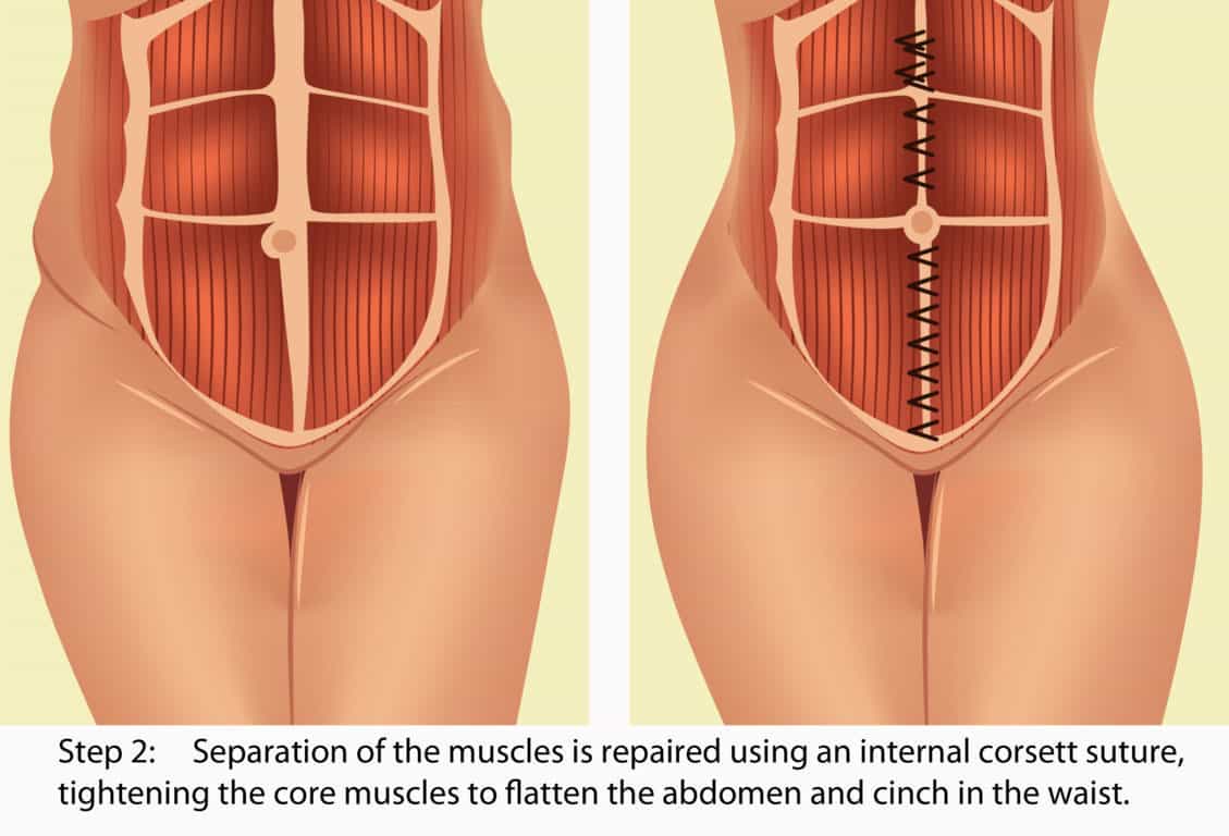 Hourglass Tummy Tuck