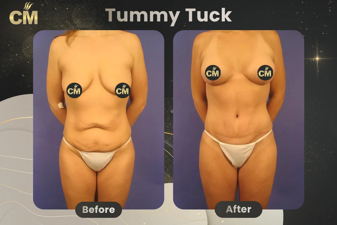 Tummy Tuck Before and After-4