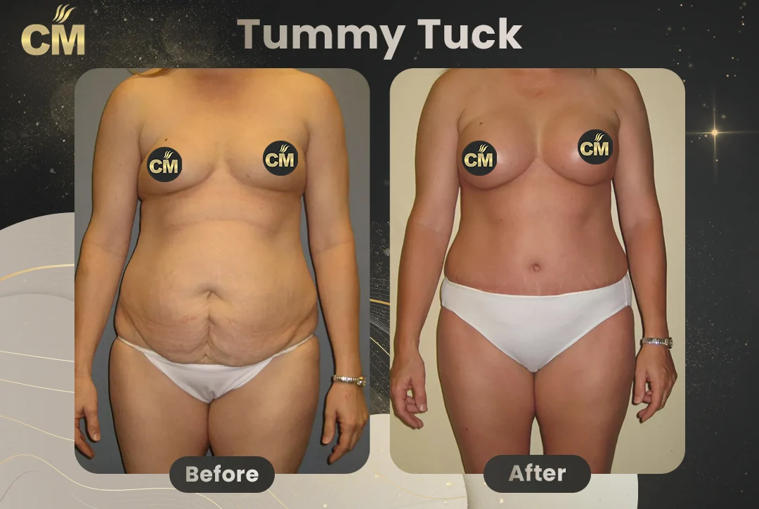 Tummy Tuck Before and After-3