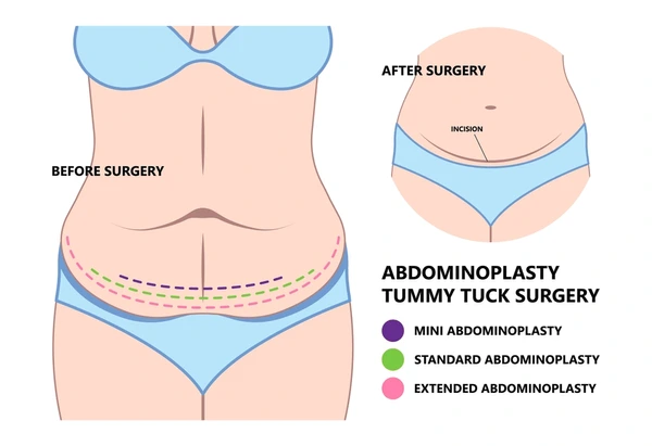 about Tummy Tuck Abdominoplasty in Turkey Surgery