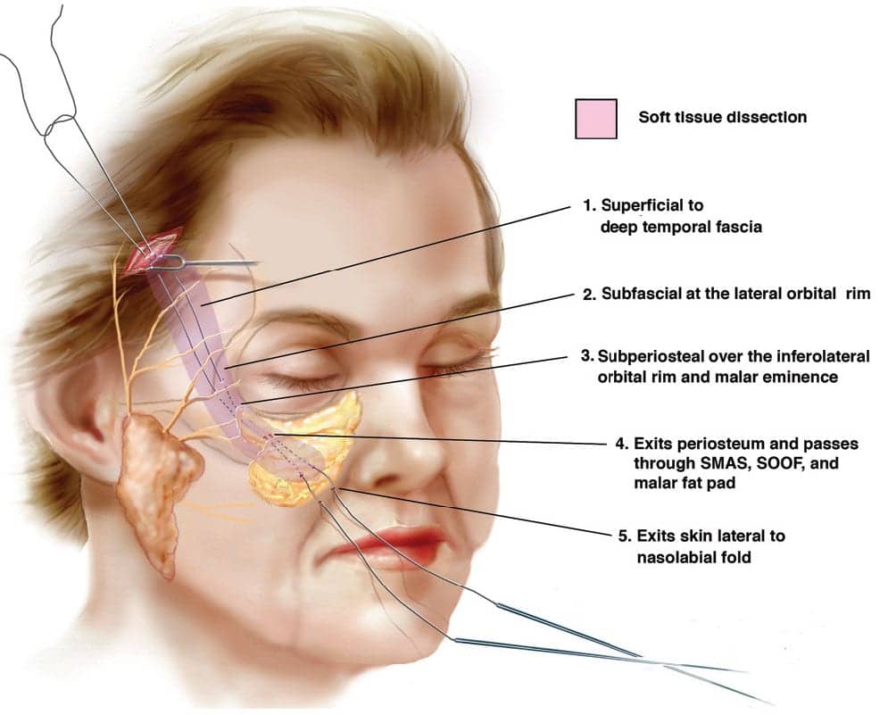 Detailed illustration of midface lift dissection path showing soft tissue layers, including SMAS, SOOF, malar fat pad, and anatomical reference points for vector-based facial elevation.