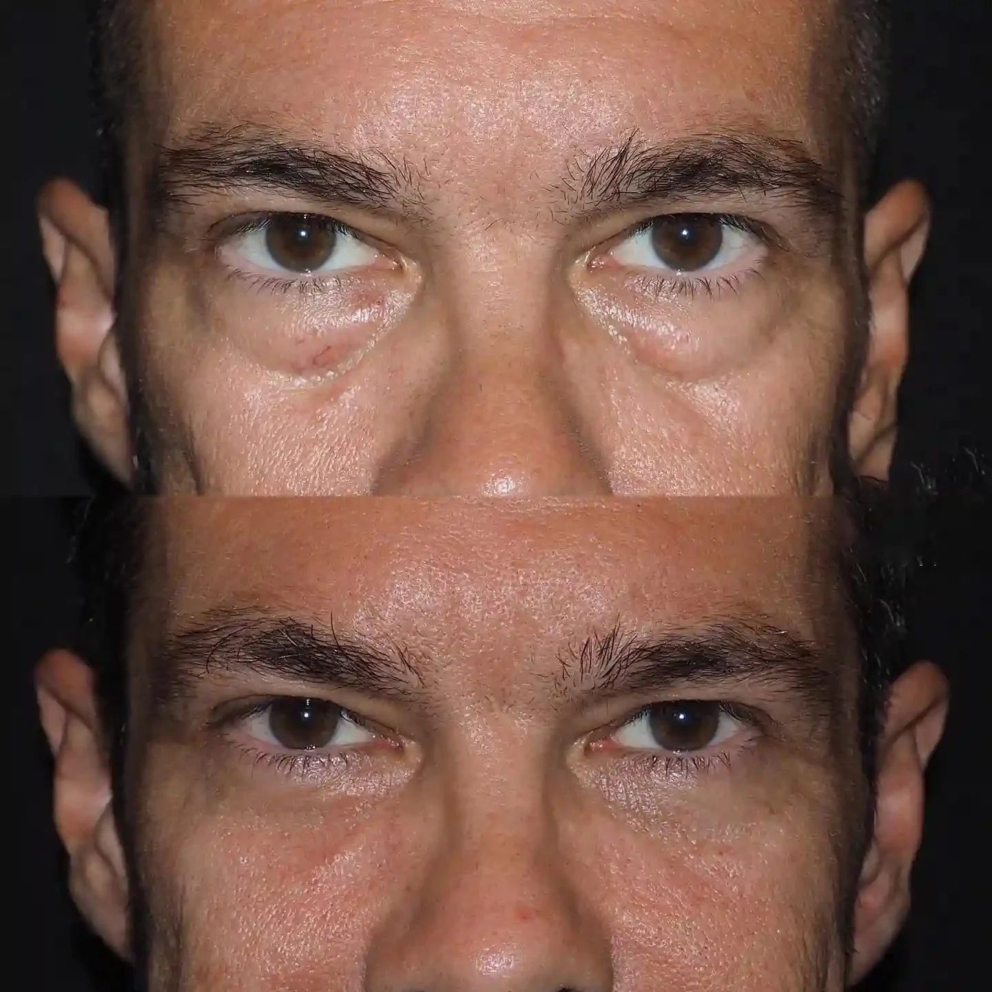 Upper Blepharoplasty before and after