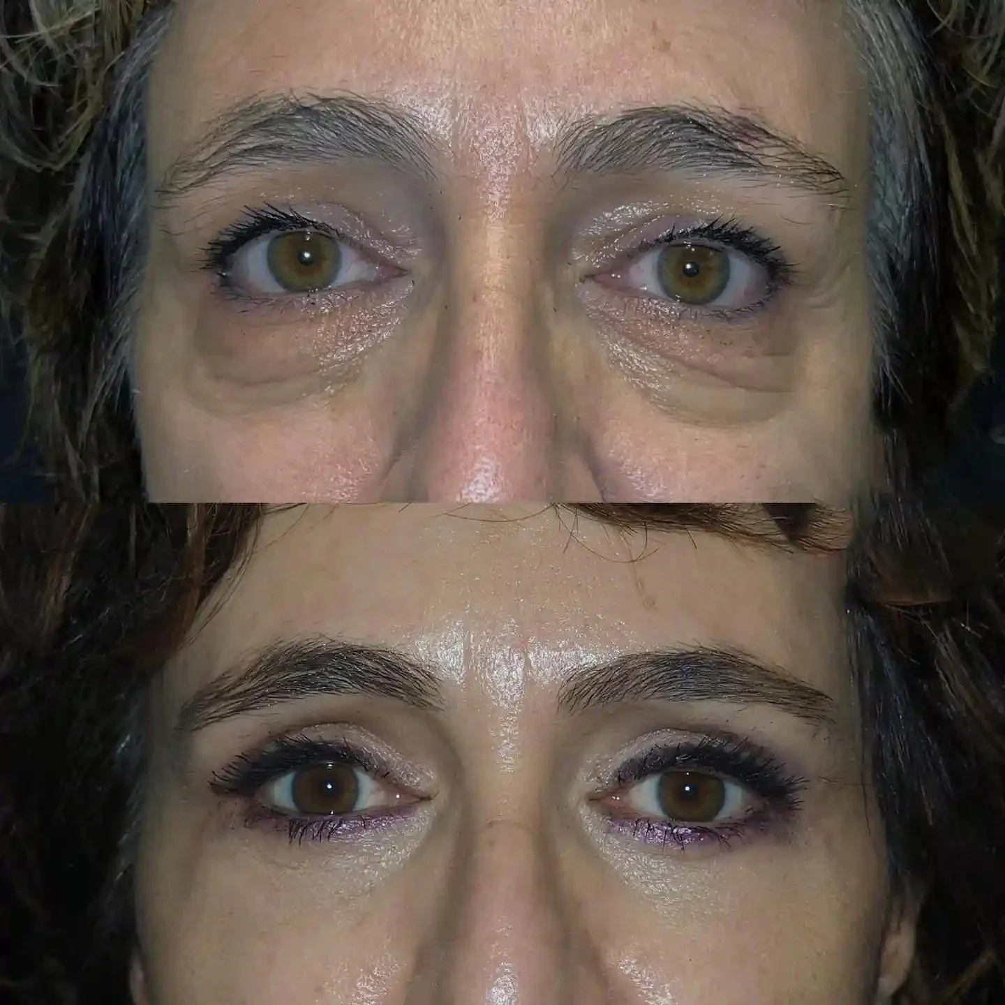 Lower Blepharoplasty before and after