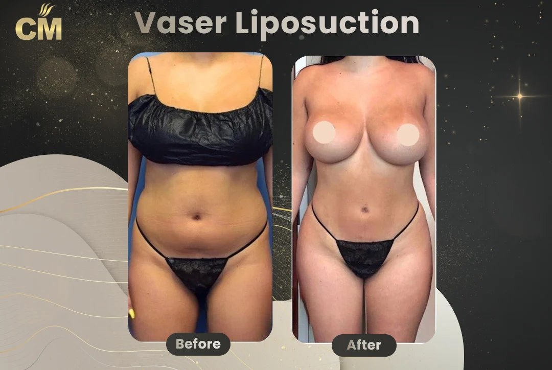 Vaser Liposuction Before and After-10