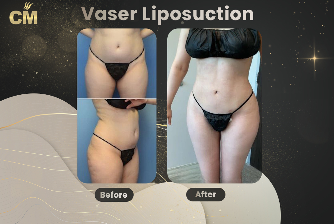 Vaser Liposuction Before and After-9