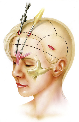 Medical illustration of endoscopic facelift technique showing incision sites on the scalp, insertion of endoscopic tools, and lifting of facial muscles and tissues through minimally invasive access points.