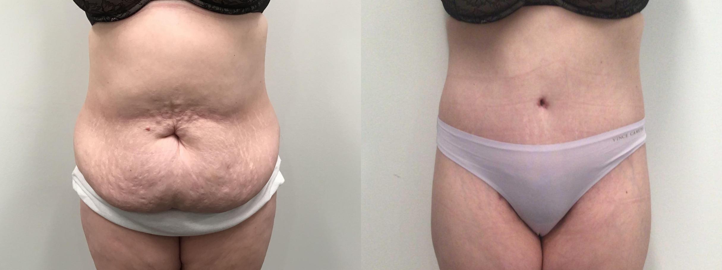 body-mass-index-bmi-categories-underweight-normal-weight-overweight-obese-obesity-extreme-obesity