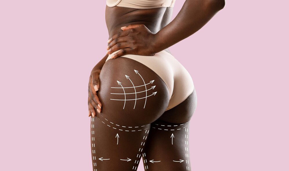 clinmedica Brazilian Butt Lift BBL