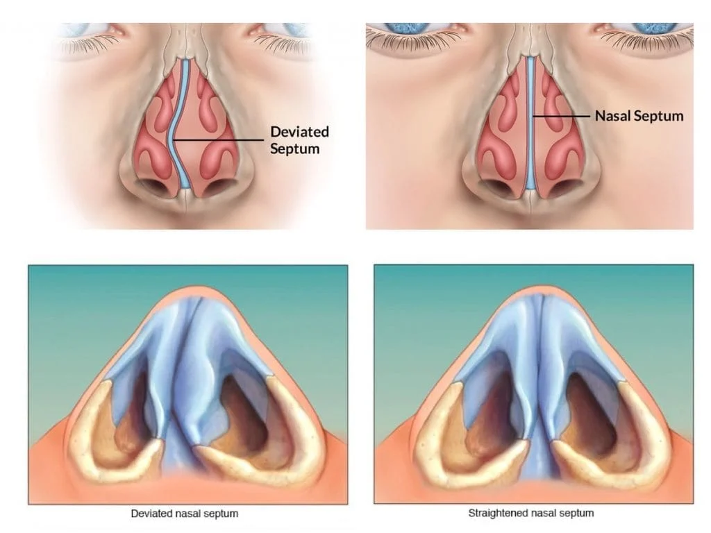 deviated and straightened septoplasty