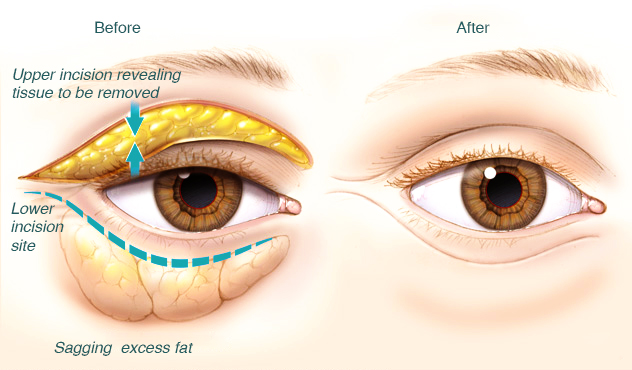 how Blepharoplasty surgery done