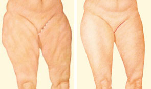 inner-thigh-lift