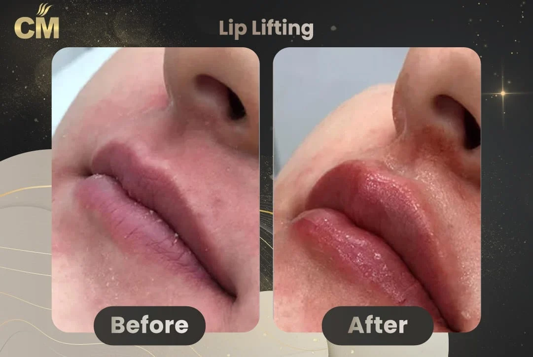 Lip Lift Before After in Turkey