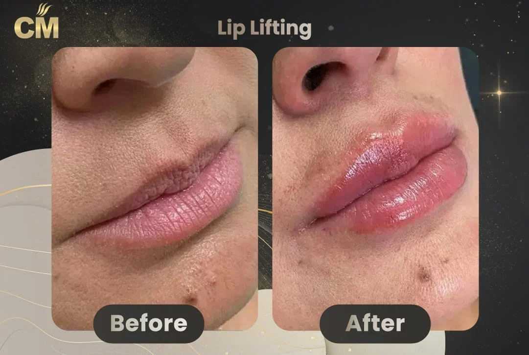 Lip Lift Before After in Turkey-1