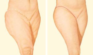 outer-thigh-lift
