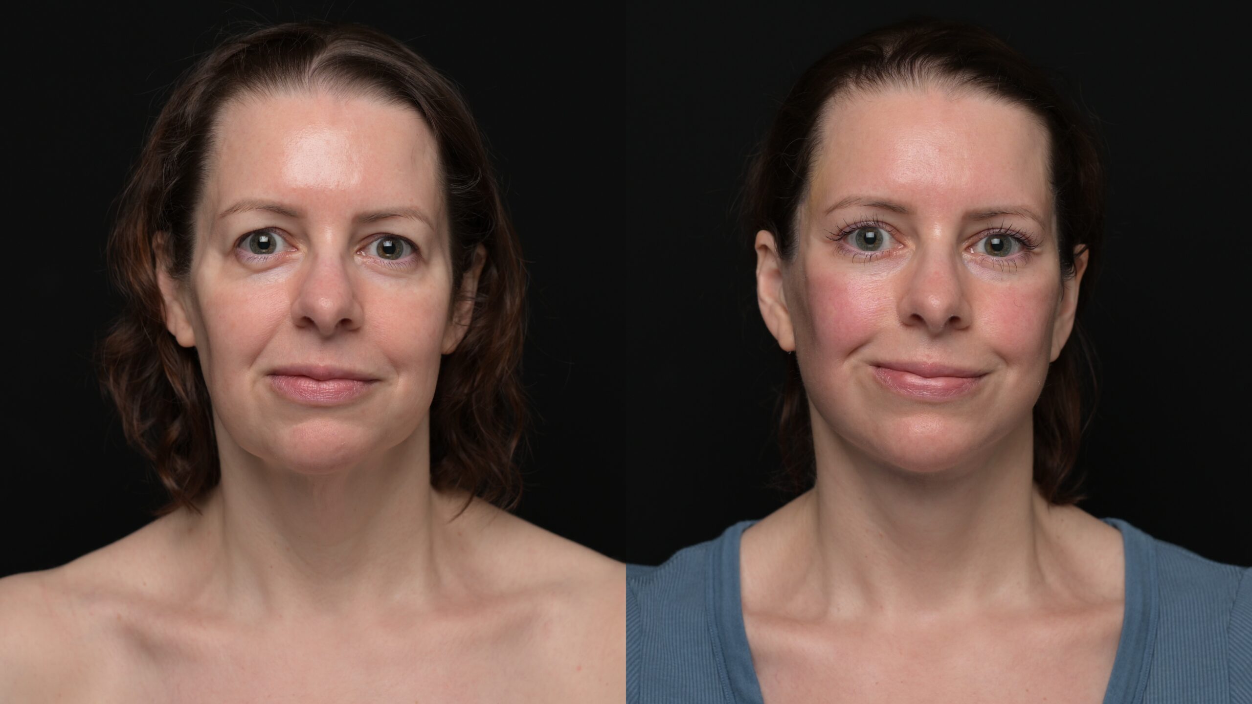 Ponytail Facelift before and after