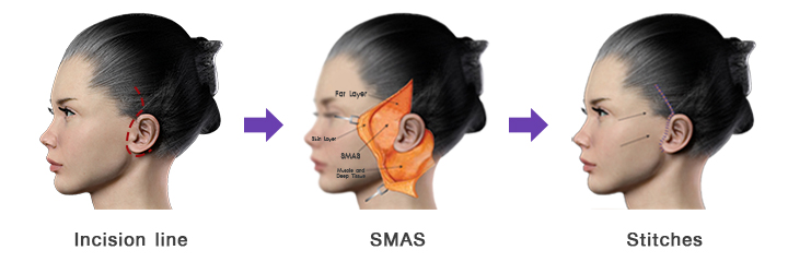 Step-by-step illustration of Ponytail Facelift surgery showing incision placement near the hairline, SMAS layer elevation, and final stitching for a lifted and scar-concealed facial rejuvenation.