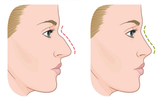 revision-rhinoplasty-plastic-surgery-clinmedica