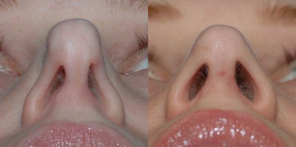 revision rhinoplasty