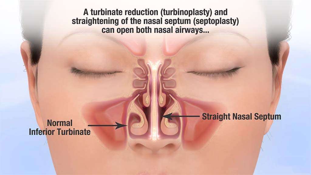 septoplasty illustrations