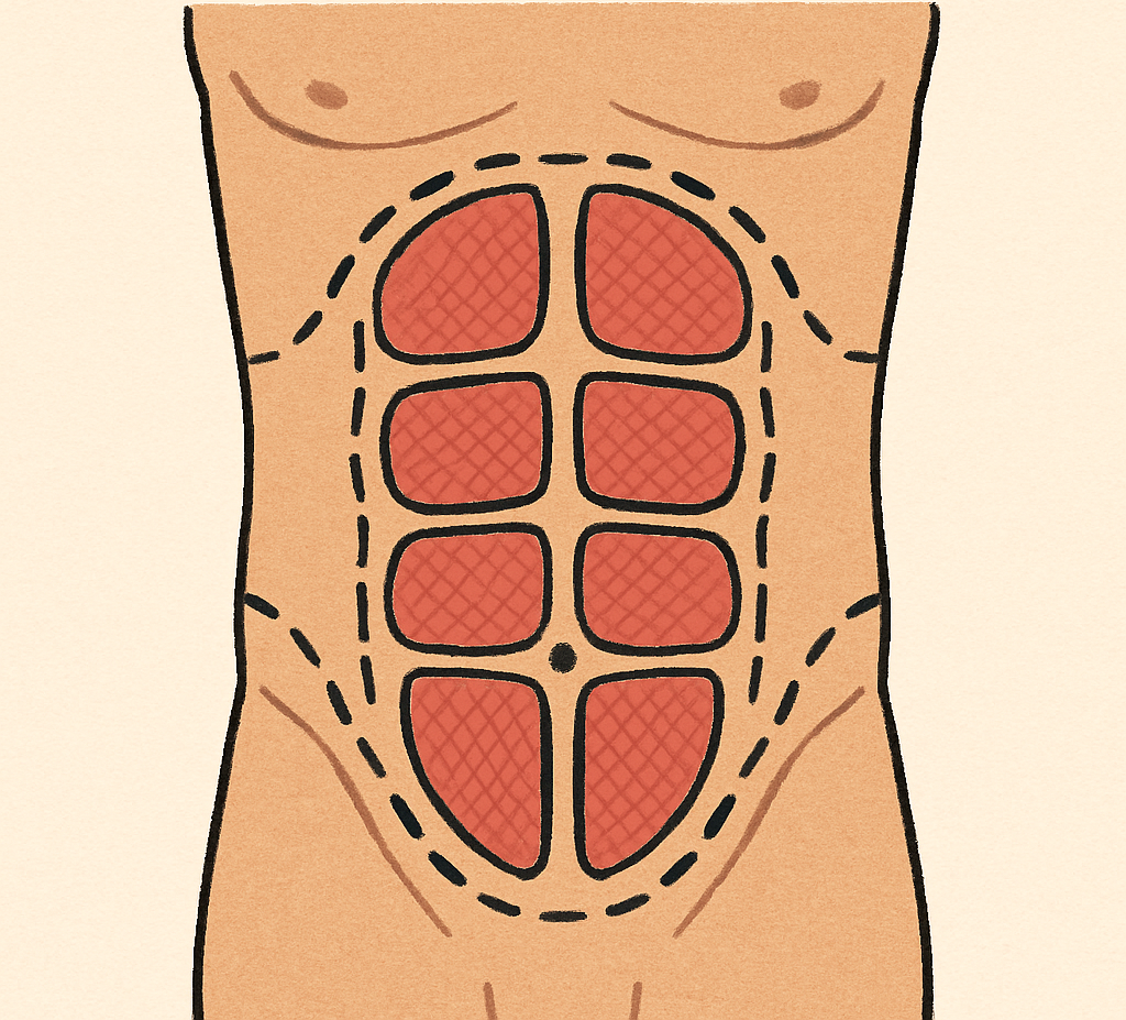 Illustration of abdominal muscles and marked zones for six-pack surgery or abdominal etching.