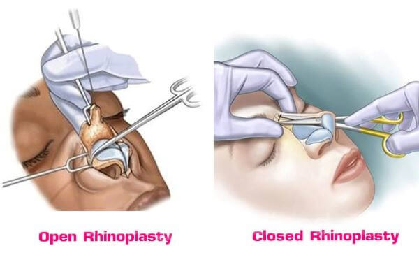 Types of Rhinoplasty Surgery in Turkey