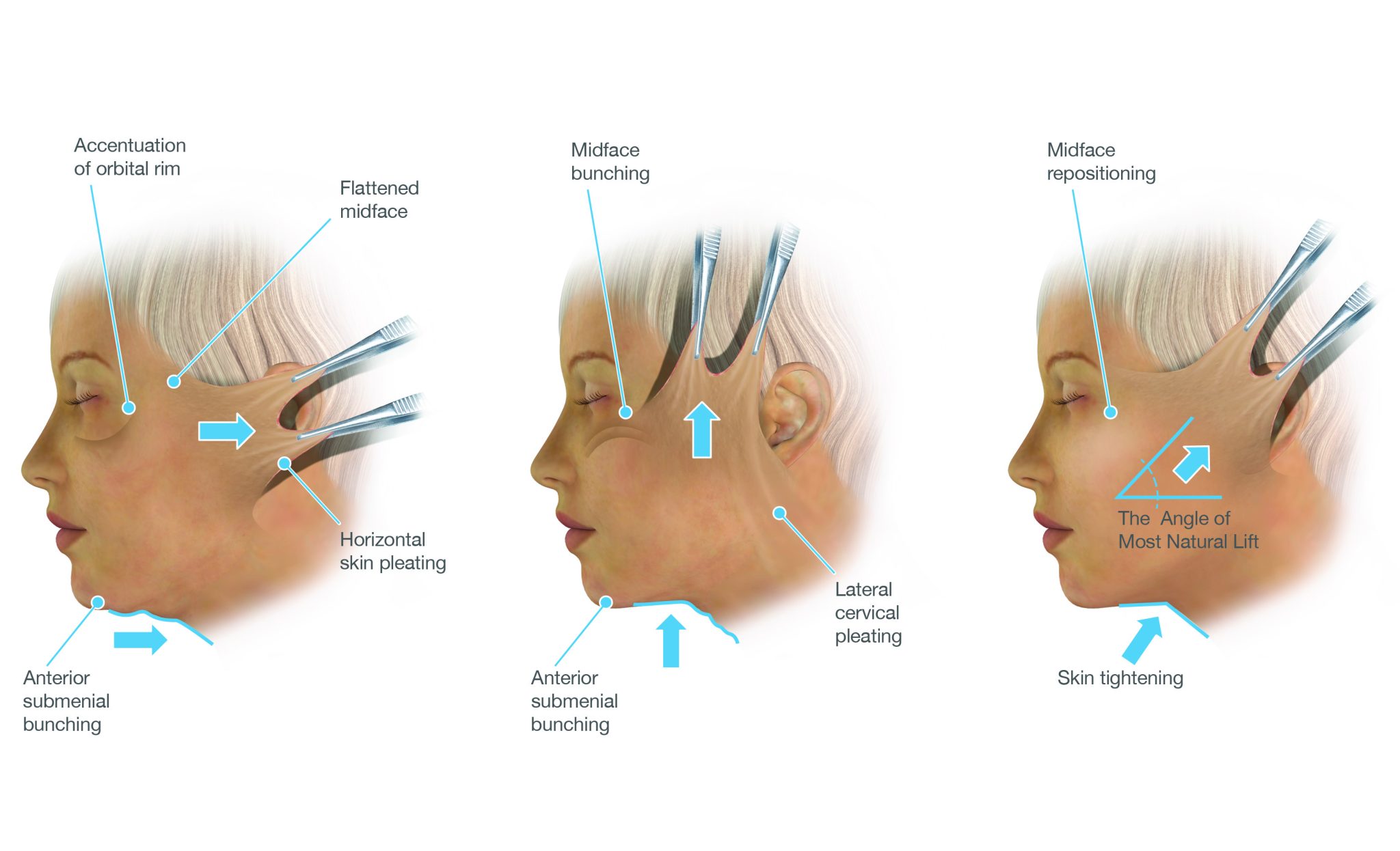 Illustration comparing traditional facelift techniques with vertical facelift, showing midface repositioning, skin pleating, and the natural angle of lift for Deep Plane Facelift outcomes