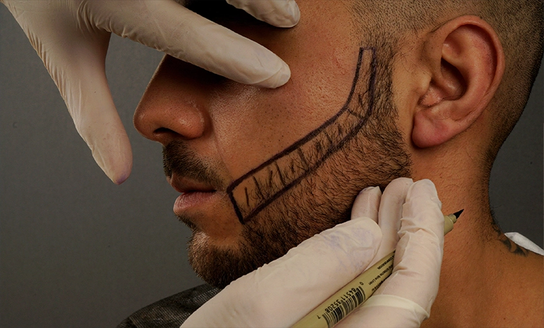 Patient after successful beard hair transplant in Turkey with visible natural growth with clinmedica