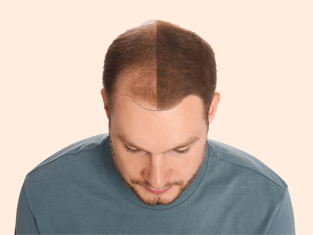 Hair Transplant Recovery - Hair Transplant Timeline