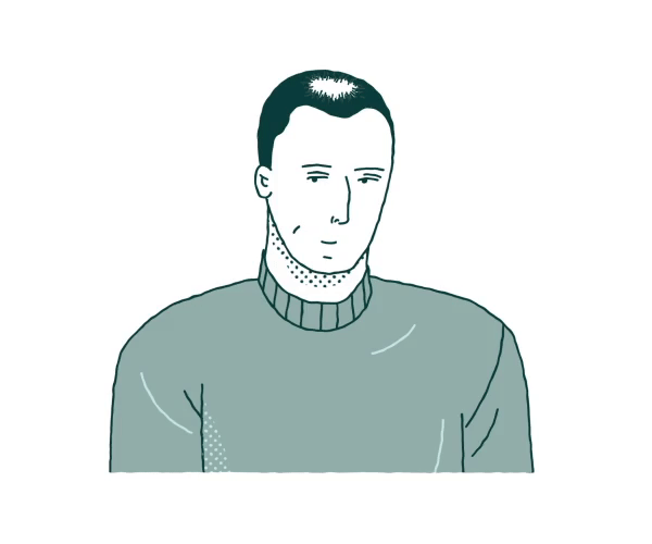what happens after hair transplant first month