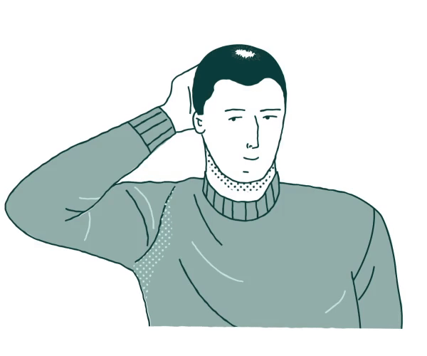 What Happens After the Third Month of a Hair Transplant