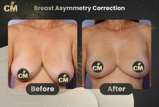 Breast Asymmetry Correction Before and After in Turkey
