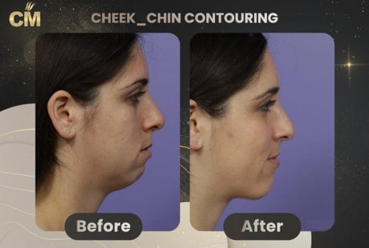 Double Chin Liposuction Before and After in Turkey