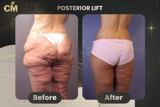 Posterior Lift Before and After in Turkey