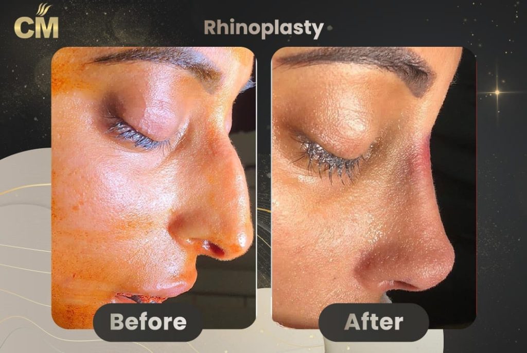 Rhinoplasty Before and After in Turkey