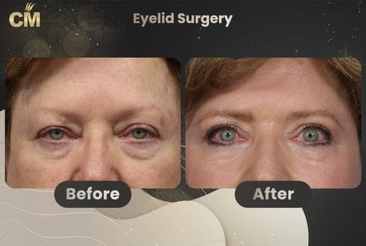 Blepharoplasty Before and After in Turkey