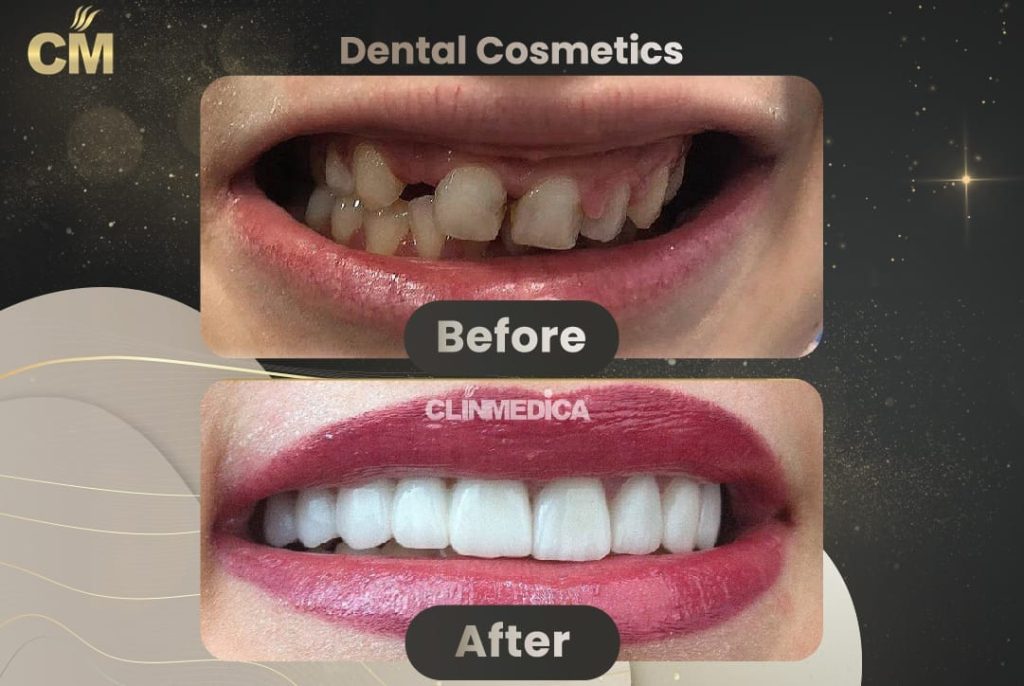 Hollywood Smile Before and After in Turkey